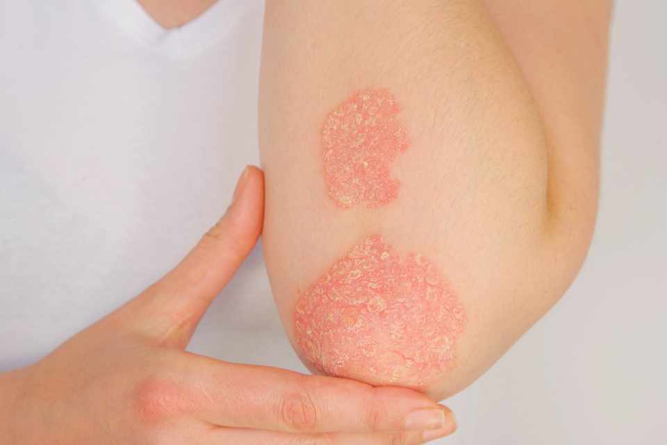 Topical herbal and natural treatments for psoriasis