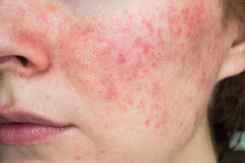 Rosacea and the gut-skin connection